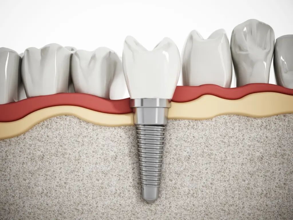 getting dental implants