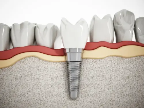 getting dental implants