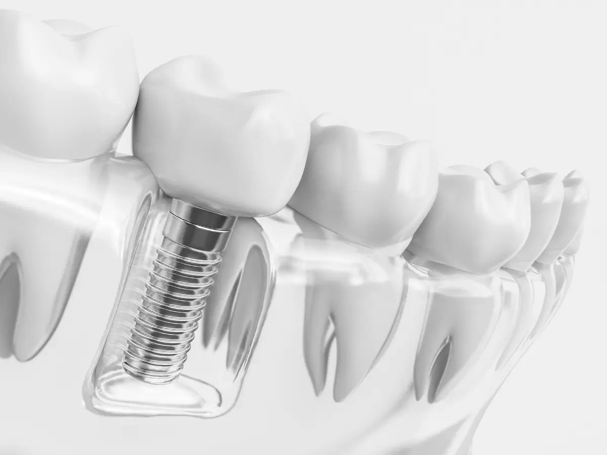 Dental Implant