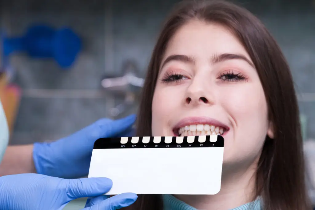 dental veneers